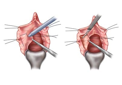 ureter-kanseri