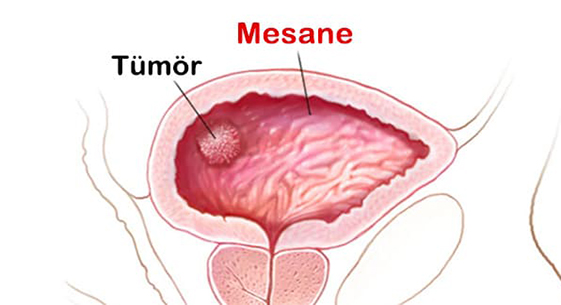 mesane-kanseri-belrtileri